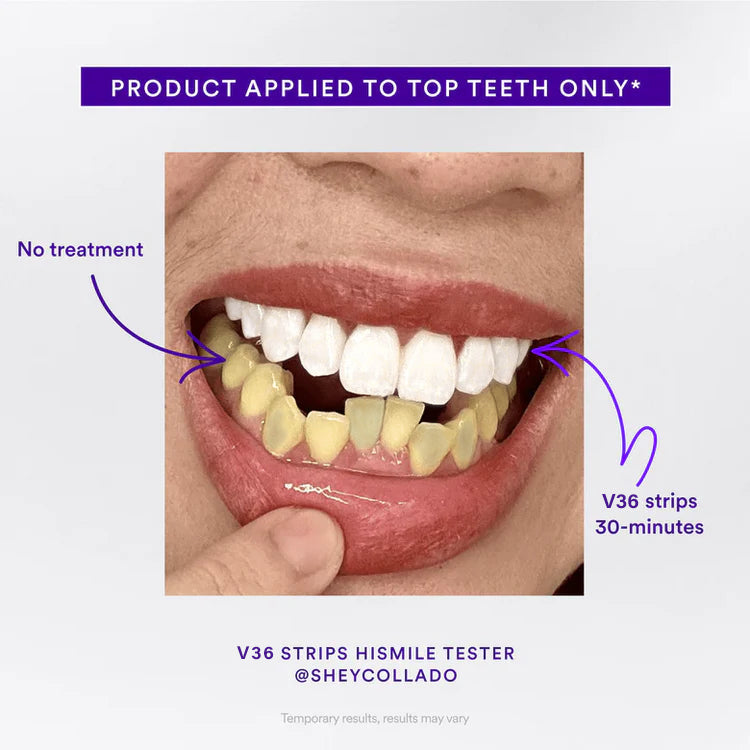 Last 3 Hours: 70% OFF🔥 - Whitening Strips -One effective result